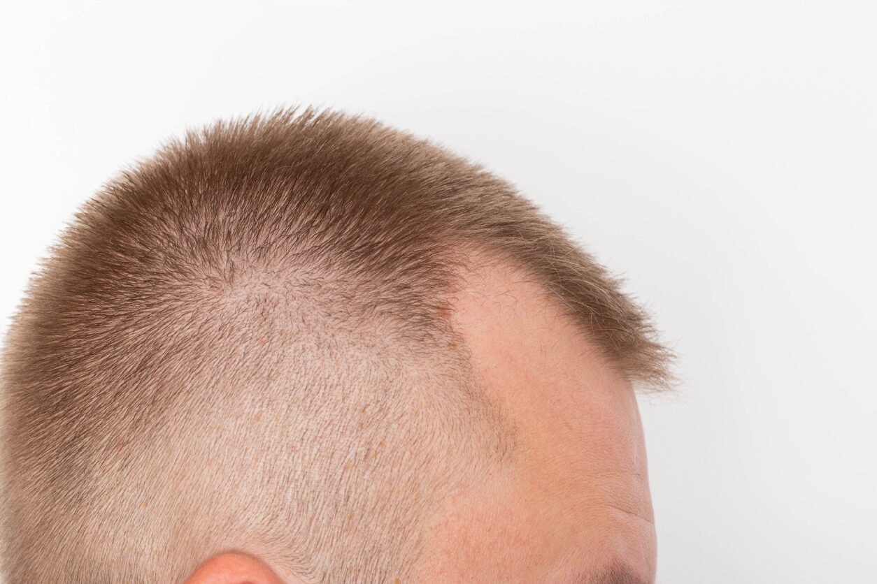 A man with a bald head is looking at the camera.