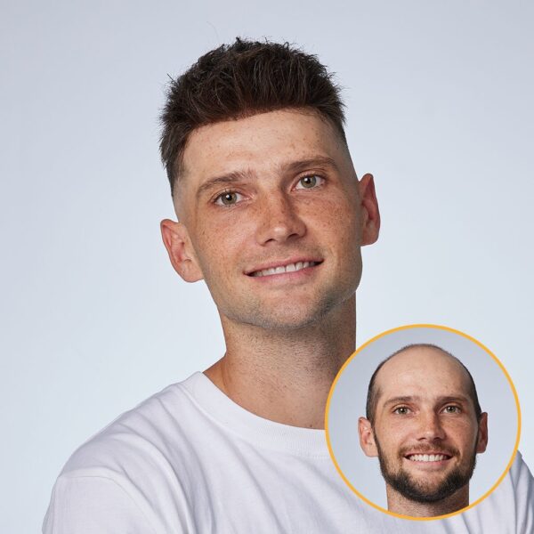 A man with a shaved head and a bald spot on his forehead.